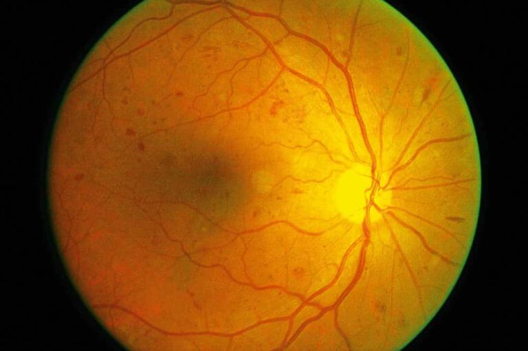 Blindness Due To Diabetic Retinopathy Surges Worldwide Florida Eye Microsurgical Institute 